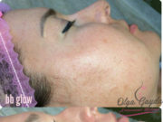 Особенности процедуры BB Glow