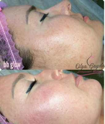 Особенности процедуры BB Glow
