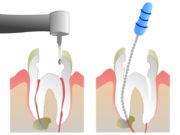 Этапы пломбирования корневых каналов