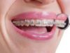 Лечение брекетами