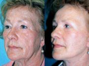 Какие могут возникнуть осложнения после подтяжки лица