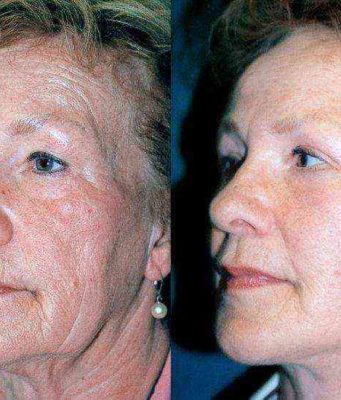 Какие могут возникнуть осложнения после подтяжки лица