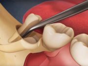 Удаление зуба мудрости и все тонкости этого процесса