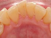 Зубной камень: причины и удаление