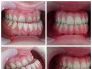 Методы исправления прикуса зубов