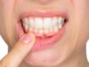 Гингивит: виды, причины и лечение заболевания