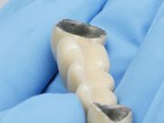 Что представляет собой металлокерамическая коронка?