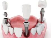 Виды имплантации зубов