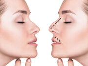 Безоперационная пластика носа: как это происходит