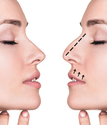 Безоперационная пластика носа: как это происходит