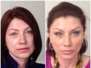 Что такое контурная пластика подбородка: эффект от процедуры