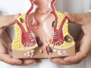 Способы лечения геморроя