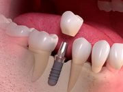 Имплантация зубов в Династии: Ваше решение для полноценной жизни без компромиссов