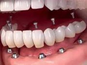 Имплантация зубов: идеальный способ для восстановления улыбки