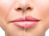 Контурная пластика носогубных складок: секрет молодости и красоты