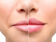 Контурная пластика носогубных складок: секрет молодости и красоты