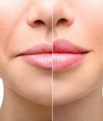 Контурная пластика носогубных складок: секрет молодости и красоты