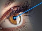 Что значит LASIK?