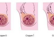 Рак молочной железы: причины, симптомы и методы лечения