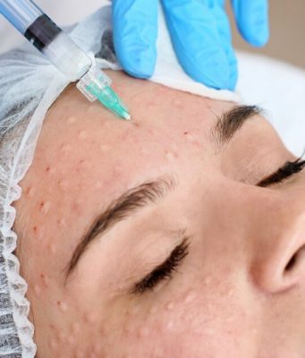 Биоревитализанты — секрет молодости кожи