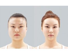 Популярность пластических операций в Корее