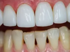 Винир на 1 зуб: эстетическая перекраска вашей улыбки