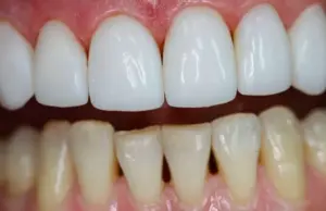 Винир на 1 зуб: эстетическая перекраска вашей улыбки