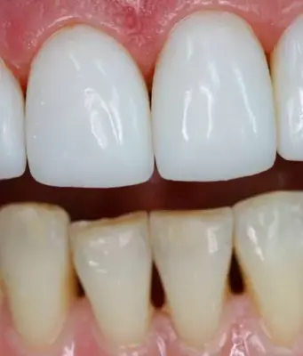 Винир на 1 зуб: эстетическая перекраска вашей улыбки