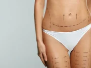 Липомоделирование до и после: омоложение внешности с минимальным риском